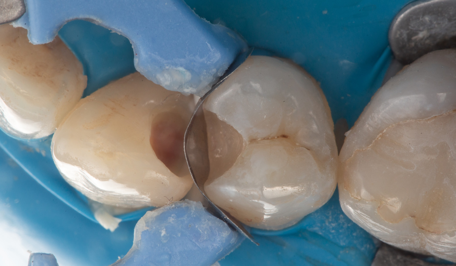 Fig. 7: Placement of a sectional matrix